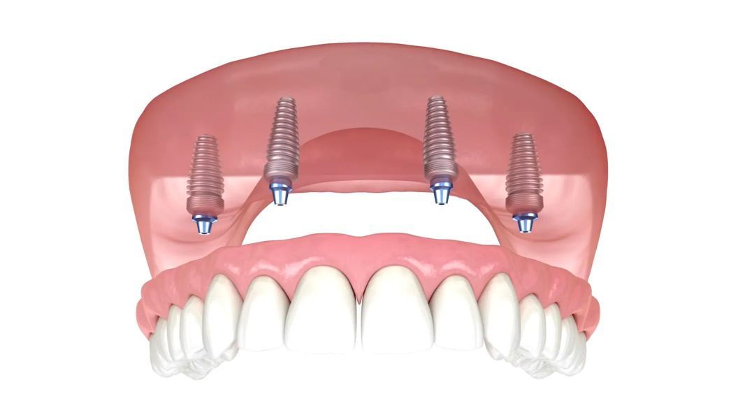 Implant placement for dentures in Southampton