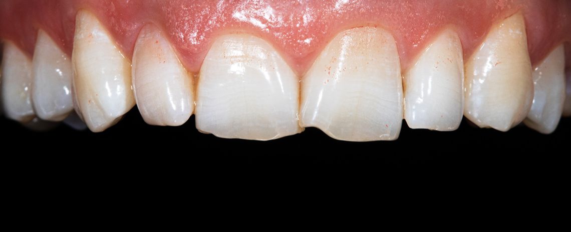 Whitening and Crowns Before